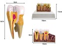 Nowoczesny model anatomiczny zęba - edukacja i prezentacja patologiami